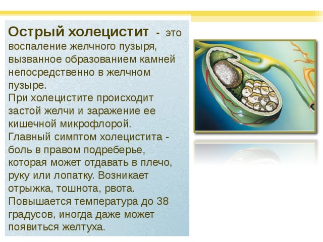 Острый холецистит - это воспаление желчного пузыря, вызванное образованием камней непосредственно в желчном пузыре. При холецистите происходит застой желчи и заражение ее кишечной микрофлорой.  Главный симптом холецистита - боль в правом подреберье, которая может отдавать в плечо, руку или лопатку. Возникает отрыжка, тошнота, рвота. Повышается температура до 38 градусов, иногда даже может появиться желтуха. 