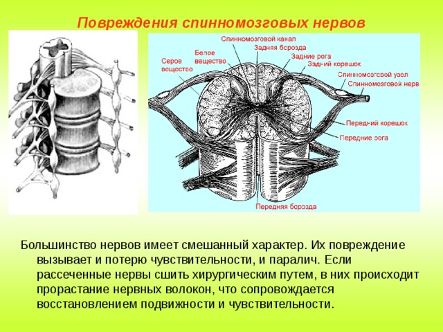 Повреждения спинномозговых нервов Большинство нервов имеет смешанный характер. Их повреждение вызывает и потерю чувствительности, и паралич. Если рассеченные нервы сшить хирургическим путем, в них происходит прорастание нервных волокон, что сопровождается восстановлением подвижности и чувствительности. 