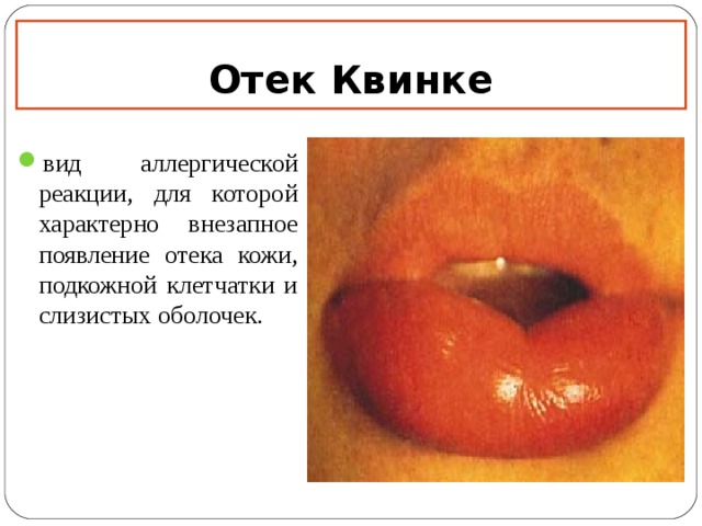 Отек Квинке вид аллергической реакции, для которой характерно внезапное появление отека кожи, подкожной клетчатки и слизистых оболочек. 12 12 