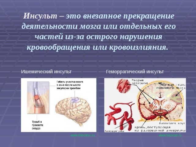 Инсульт  – это внезапное прекращение деятельности мозга или отдельных его частей из-за острого нарушения кровообращения или кровоизлияния. Ишемический инсульт Геморрагический инсульт www.trezvost.ru  www.minclinic.ru 