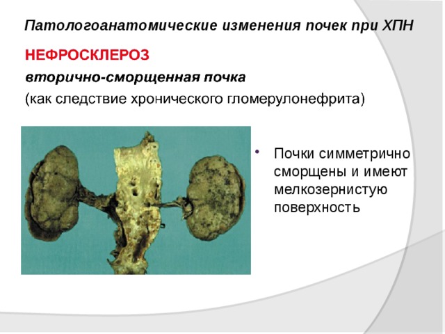 Микро изменение. Первично сморщенная почка макропрепарат. Первичное сморщивание почки. Вторичносморшененя почка.