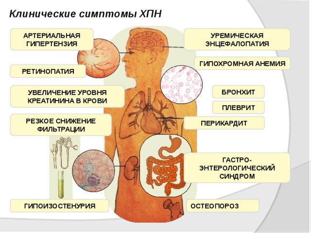 Энцефалопатия на фоне почечной недостаточности