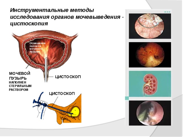 Осмотр мочевого пузыря на кресле