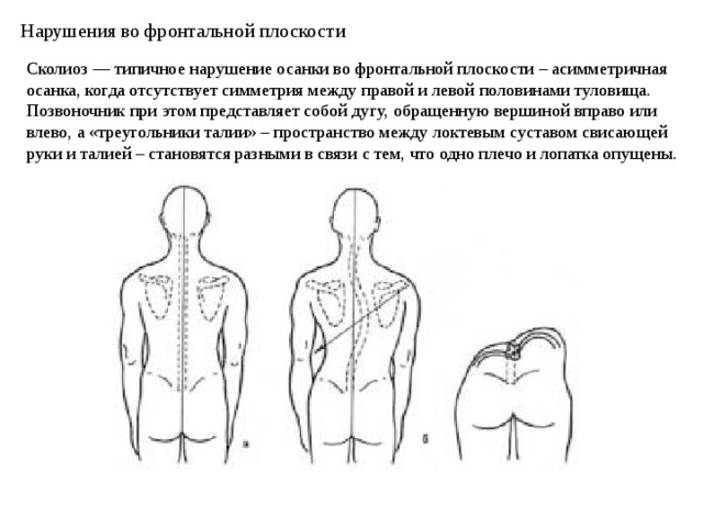 Нарушения во фронтальной плоскости   Сколиоз — типичное нарушение осанки во фронтальной плоскости – асимметричная осанка, когда отсутствует симметрия между правой и левой половинами туловища. Позвоночник при этом представляет собой дугу, обращенную вершиной вправо или влево, а «треугольники талии» – пространство между локтевым суставом свисающей руки и талией – становятся разными в связи с тем, что одно плечо и лопатка опущены.    