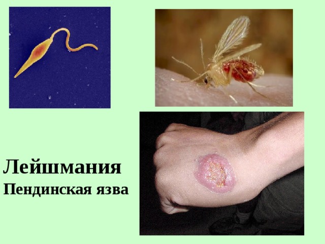 Лейшмания Пендинская язва 