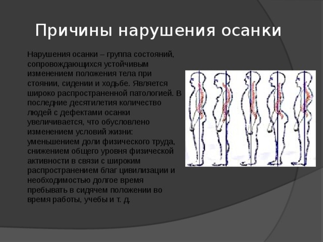 Причины нарушения осанки Нарушения осанки – группа состояний, сопровождающихся устойчивым изменением положения тела при стоянии, сидении и ходьбе. Является широко распространенной патологией. В последние десятилетия количество людей с дефектами осанки увеличивается, что обусловлено изменением условий жизни: уменьшением доли физического труда, снижением общего уровня физической активности в связи с широким распространением благ цивилизации и необходимостью долгое время пребывать в сидячем положении во время работы, учебы и т. д.   