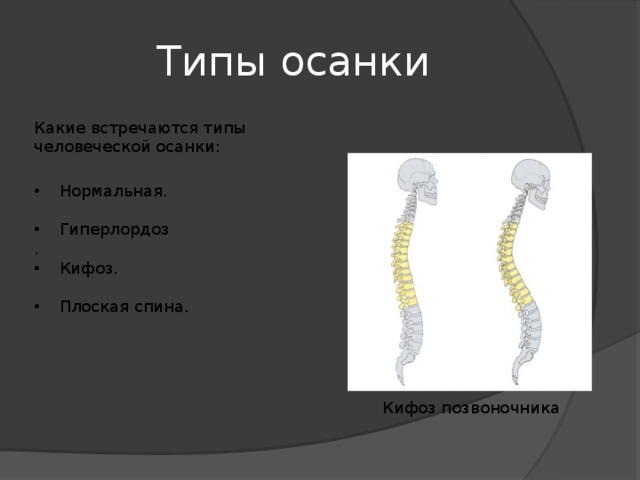Типы осанки Какие встречаются типы человеческой  осанки:  Нормальная.  Гиперлордоз .  Кифоз.  Плоская спина. Кифоз позвоночника 