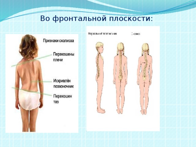 Фронтальная плоскость позвоночника. Искривление осанки во фронтальной плоскости. Нарушение осанки во фронтальной плоскости. Искривление позвоночника во фронтальной плоскости. Нарушение осанки в сагиттальной плоскости.