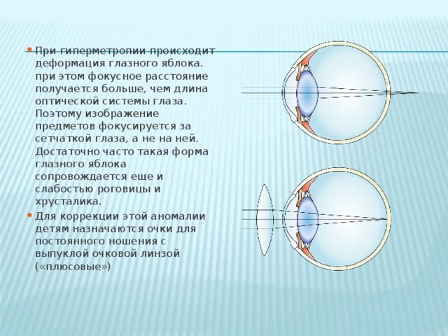 Если изображение фокусируется перед сетчаткой глаза возникает