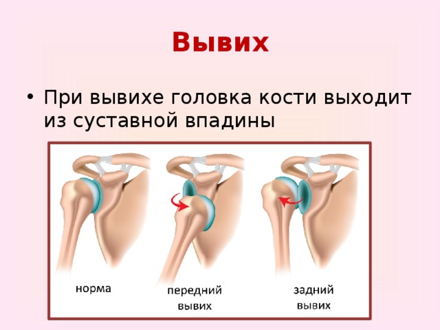 Вывих плеча презентация