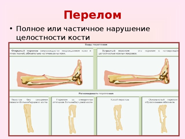 Первая помощь при повреждении скелета и мышц