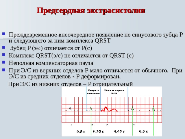 Экстрасистолы ощущения. Единичная предсердная экстрасистола. Предсердная экстрасистолия. Блокированная предсердная экстрасистола. Одиночные предсердные экстрасистолы.