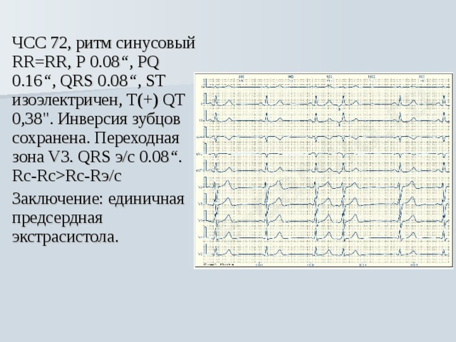 Pq 0 09. Смещение переходной зоны на ЭКГ. Синусовый ритм 72. Переходная зона смещена вправо на ЭКГ. Смещение переходной зоны влево на ЭКГ.