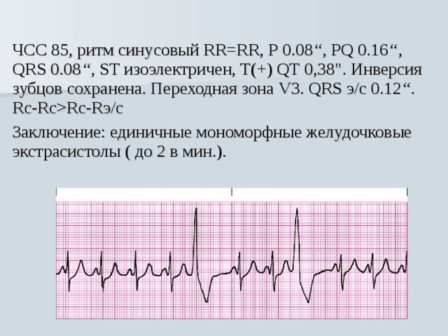 Синусовый ритм qrs. Мономорфные желудочковые экстрасистолы. Мономорфные парные желудочковые экстрасистолы. Ритм синусовый PQ. Мономорфная желудочковая тахикардия ЭКГ.
