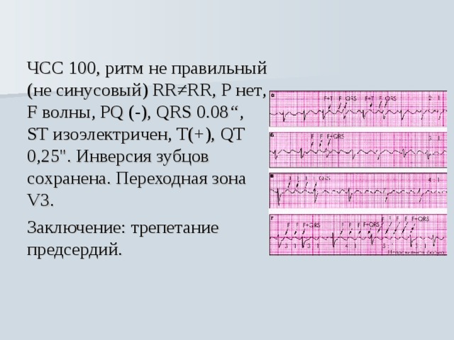 Синусовый ритм с чсс