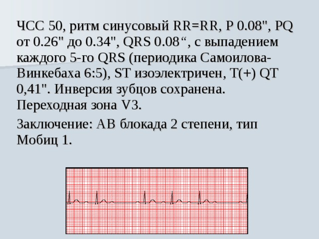 Синусовый ритм 57. Синусовый ритм с ЧСС.