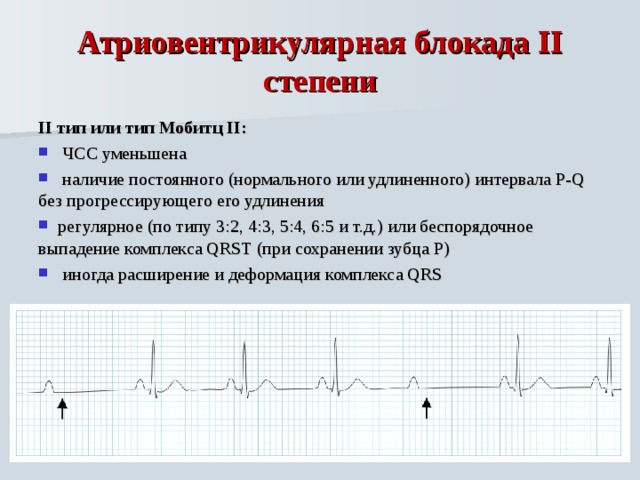 Ав блокада 2. Атриовентрикулярная блокада 2 степени 2 типа. Са блокада 2 степени типа Мобитц. АВ блокада 2 степени ЧСС. Атриовентрикулярная блокада Мобитц 3.