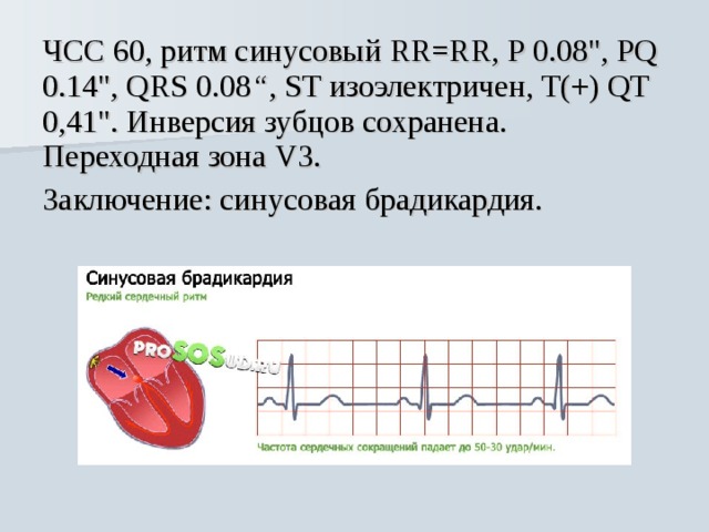 Что значить синусовый ритм. Ритм синусовый чсс55 брадикардия. ЭКГ брадикардия синусовый ритм. Синусовая брадикардия ЭКГ заключение. Синусовый ритм с ЧСС 60.