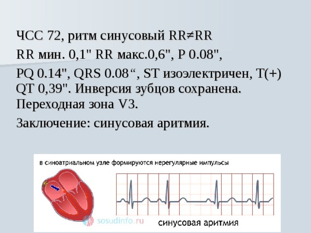 Синусовый ритм с чсс