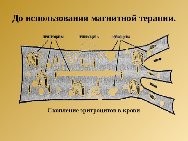 До использования магнитной терапии. Скопление эритроцитов в крови 