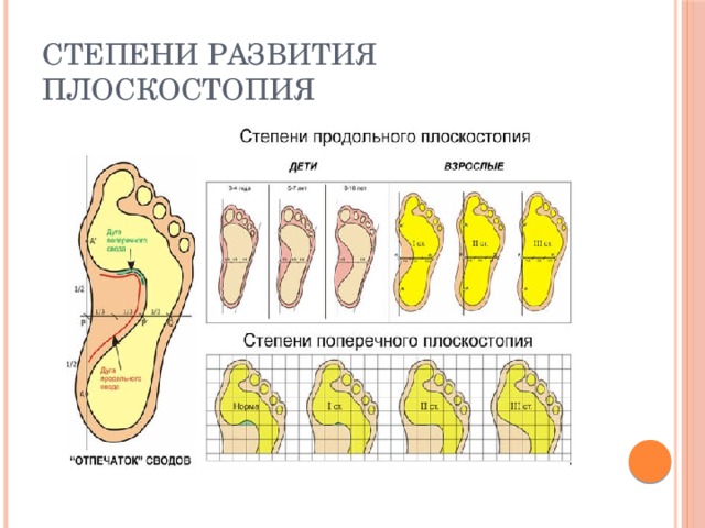  Степени развития плоскостопия 