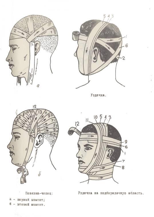 Повязка уздечка. Повязка чепец техника. Повязки на голову чепец и уздечка. Наложение повязки уздечка. Повязка уздечка техника наложения.