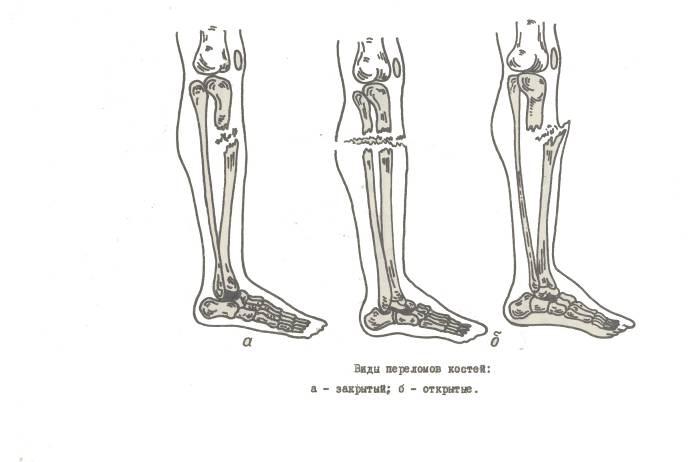 Переломы нижних конечностей