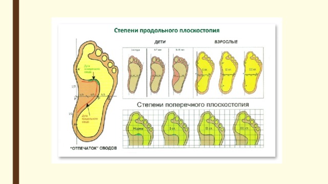 Картинки на тему плоскостопие