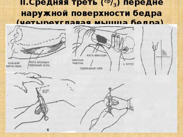 Схема введения внутримышечной инъекции