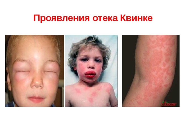 Проявления отека Квинке 