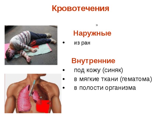 Кровотечения    Наружные  из ран  Внутренние    под кожу (синяк)  в мягкие ткани (гематома)  в полости организма  