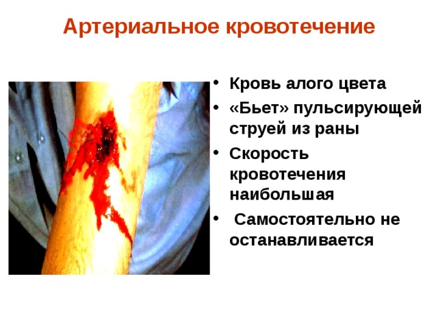 Артериальное кровотечение Кровь алого цвета «Бьет» пульсирующей струей из раны Скорость кровотечения наибольшая  Самостоятельно не останавливается 