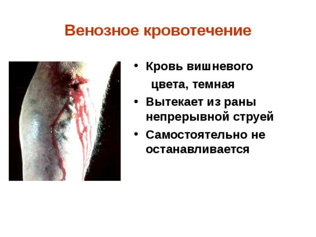 Венозное кровотечение Кровь вишневого  цвета, темная Вытекает из раны непрерывной струей Самостоятельно не останавливается 