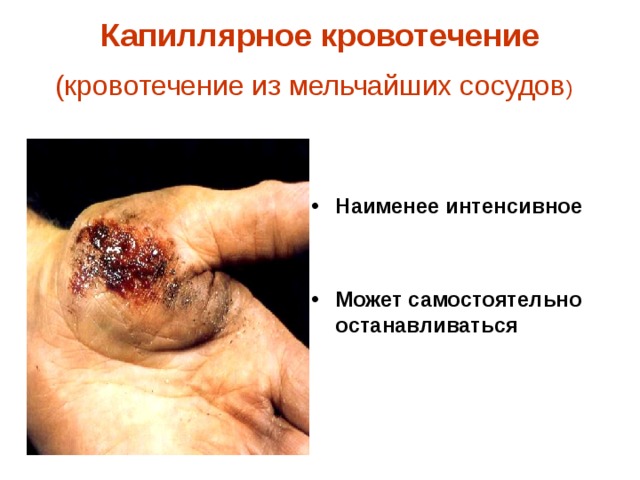 Капиллярное кровотечение  (кровотечение из мельчайших сосудов )  Наименее интенсивное   Может самостоятельно останавливаться  