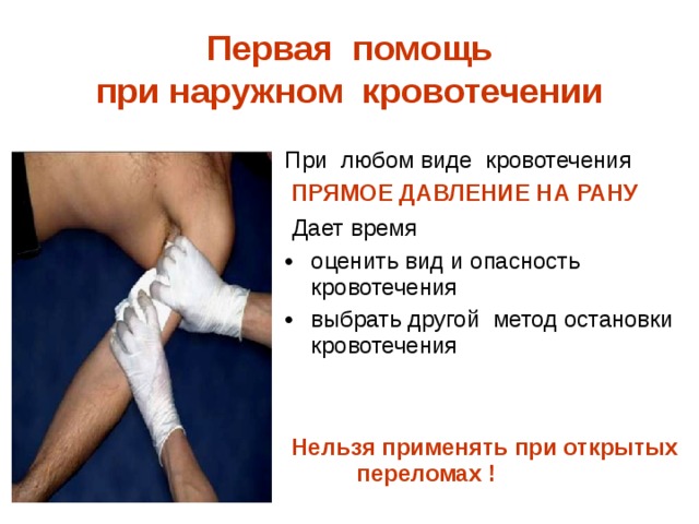 Первая помощь  при наружном кровотечении   При любом виде кровотечения   ПРЯМОЕ ДАВЛЕНИЕ НА РАНУ  Дает время оценить вид и опасность кровотечения выбрать другой метод остановки кровотечения  Нельзя применять при открытых переломах ! 