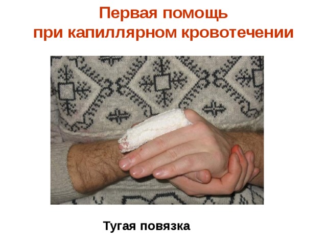 Первая помощь  при капиллярном кровотечении    Тугая повязка 