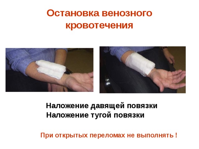 Остановка венозного кровотечения  Наложение давящей повязки Наложение тугой повязки При открытых переломах не выполнять ! 