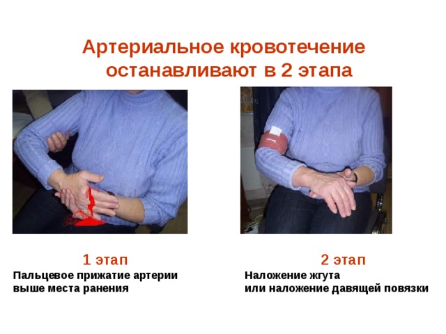 Артериальное кровотечение  останавливают в 2 этапа 1 этап 2 этап Пальцевое прижатие артерии выше места ранения Наложение жгута или наложение давящей повязки 