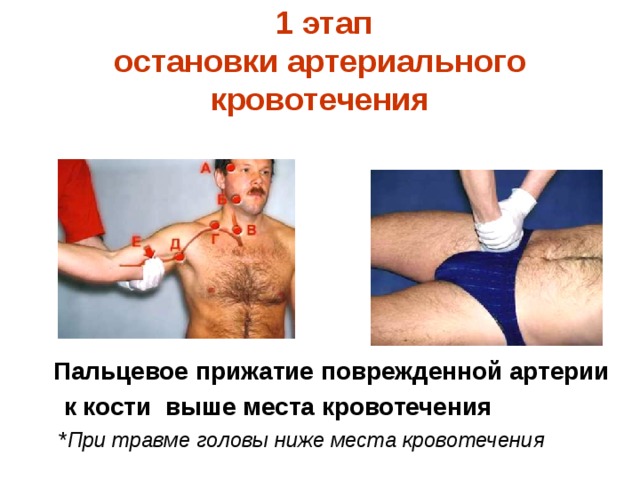   1 этап  остановки артериального кровотечения    Пальцевое прижатие поврежденной артерии  к кости выше места кровотечения  * При травме головы ниже места кровотечения  