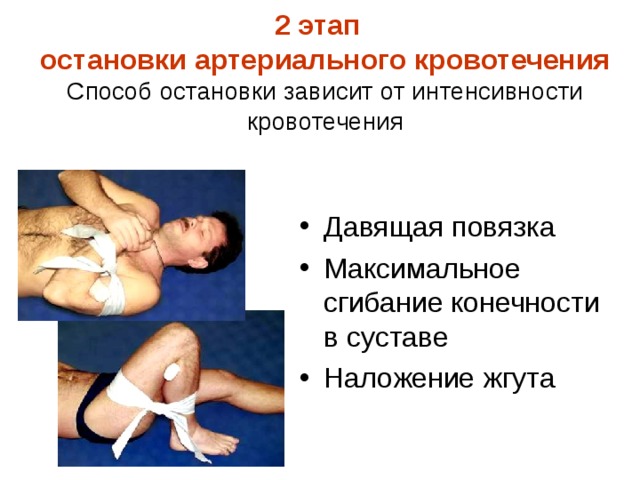   2 этап  остановки артериального кровотечения  Способ остановки зависит от интенсивности кровотечения    Давящая повязка Максимальное сгибание конечности в суставе Наложение жгута 