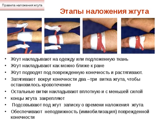 Правила наложения жгута Этапы наложения жгута Жгут накладывают на одежду или подложенную ткань Жгут накладывают как можно ближе к ране Жгут подводят под поврежденную конечность и растягивают. Затягивают вокруг конечности два –три витка жгута, чтобы остановилось кровотечение Остальные витки накладывают вплотную и с меньшей силой концы жгута закрепляют  Подсовывают под жгут записку о времени наложения жгута Обеспечивают неподвижность (иммобилизация) поврежденной конечности 