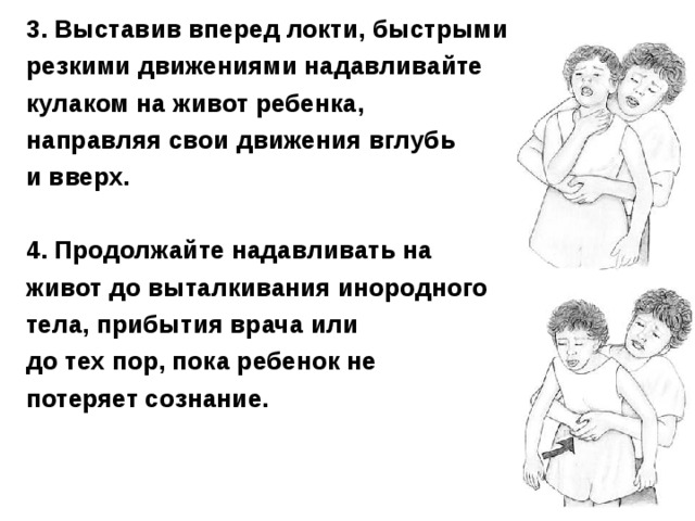 3. Выставив вперед локти, быстрыми резкими движениями надавливайте кулаком на живот ребенка, направляя свои движения вглубь и вверх.   4. Продолжайте надавливать на живот до выталкивания инородного тела, прибытия врача или до тех пор, пока ребенок не потеряет сознание.      