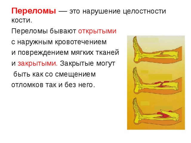Переломы — это нарушение целостности кости. Переломы бывают открытыми  с наружным кровотечением и повреждением мягких тканей и закрытыми. Закрытые могут  быть как со смещением отломков так и без него. 
