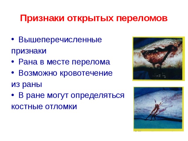 Признаки открытых переломов Вышеперечисленные признаки Рана в месте перелома Возможно кровотечение из раны В ране могут определяться костные отломки 