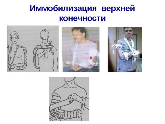 Иммобилизация верхней конечности 
