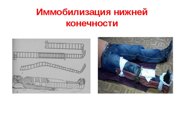 Иммобилизация нижней конечности 