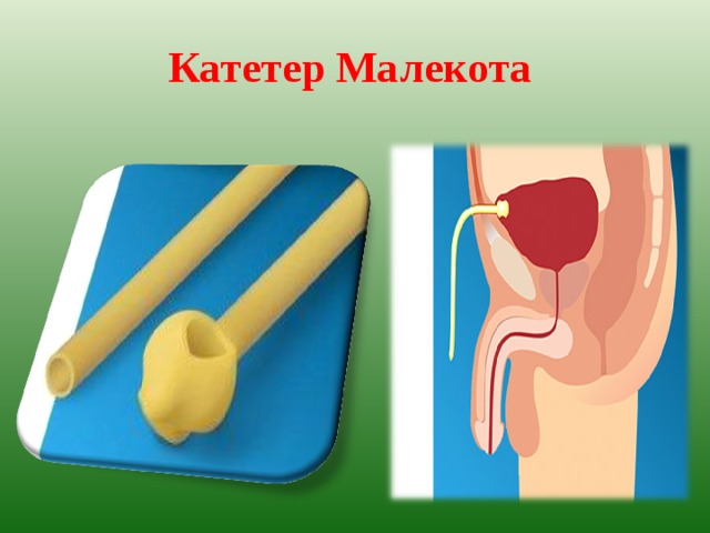Как правильно снять мочевой катетер