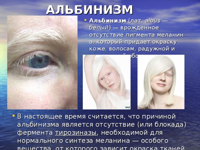 Альбинизмом страдают. Клинические симптомы альбинизма. Альбинизм наследственное заболевание. Альбинизм клинические проявления.