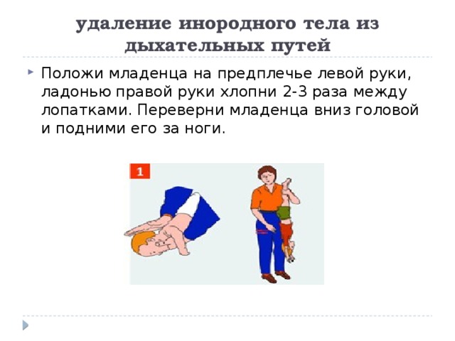 удаление инородного тела из дыхательных путей Положи младенца на предплечье левой руки, ладонью правой руки хлопни 2-3 раза между лопатками. Переверни младенца вниз головой и подними его за ноги. 