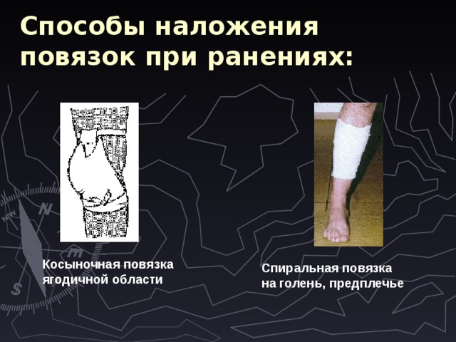 Способы наложения повязок при ранениях: Косыночная повязка ягодичной области  Спиральная повязка на голень, предплечье  